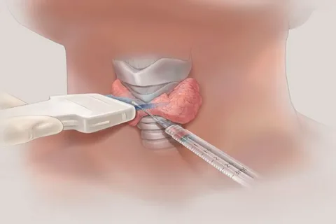 Thyroidectomy