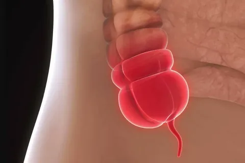 Appendectomy