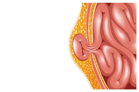 Inguinal hernia