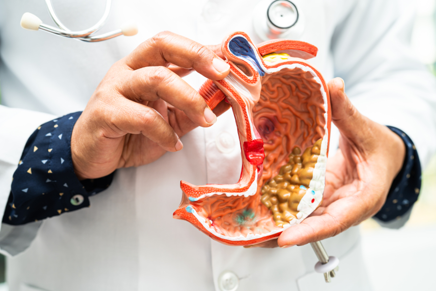 Laparoscopic Cholecystectomy (Gallbladder Removal)