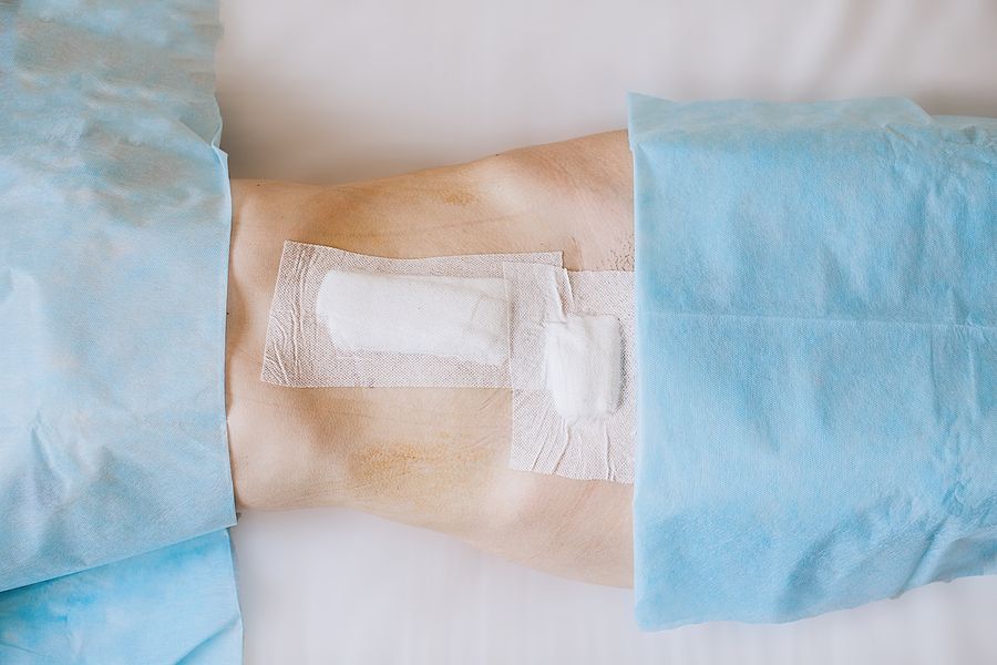 Umbilical hernia