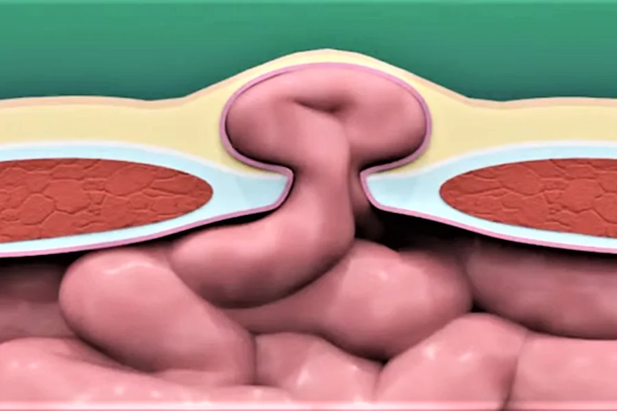 Abdominal surgeries